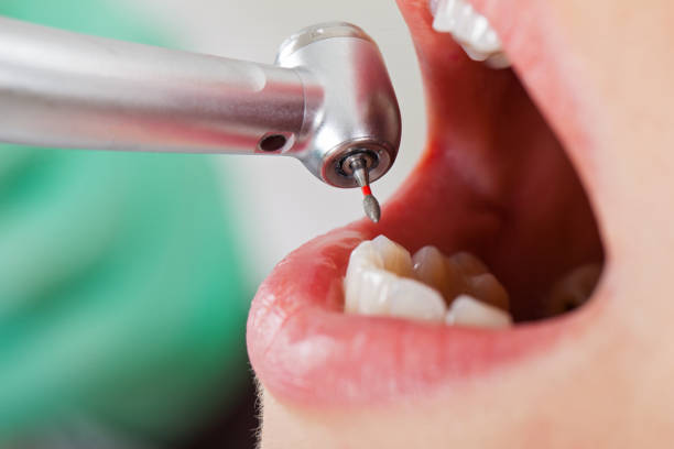 Best Emergency Tooth Extraction in Huber Ridge, OH